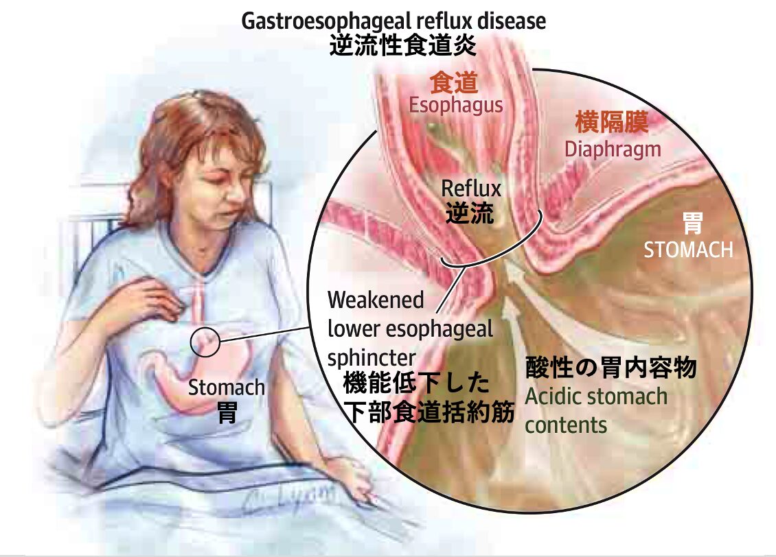 逆流性食道炎