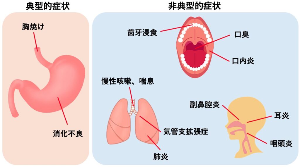 逆流性食道炎の症状