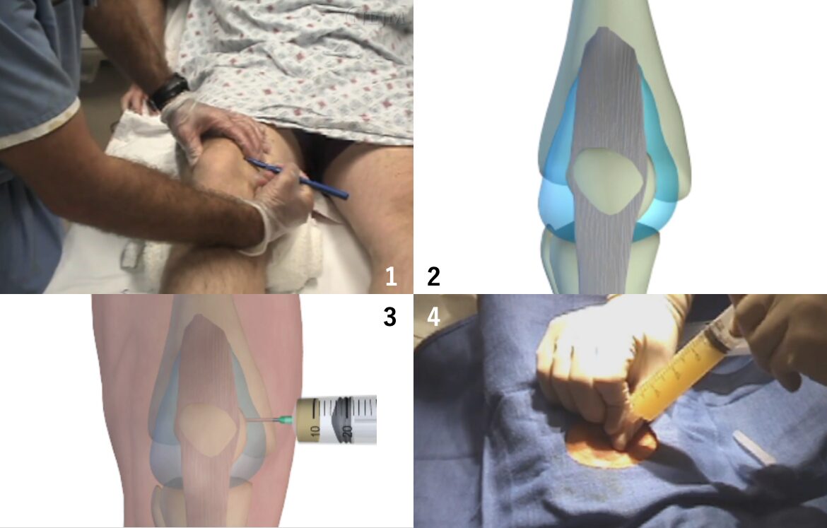 関節穿刺(Arthrocentesis)