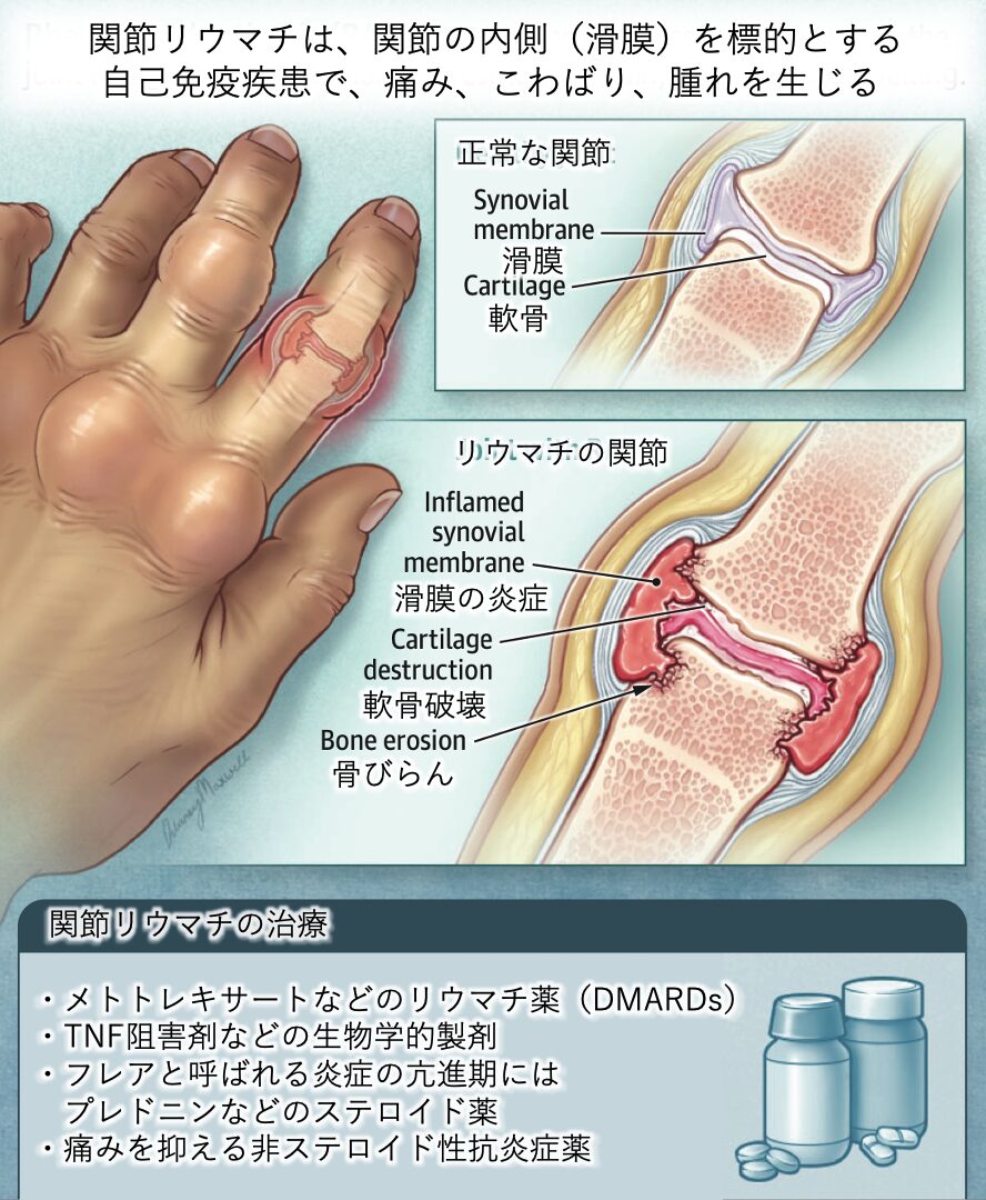 関節リウマチ